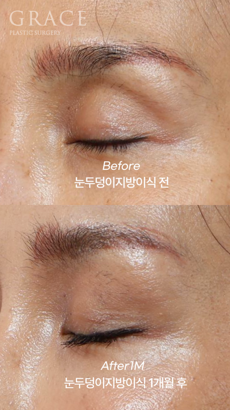 Uneven When You Close Your Eyes? Before-and-After of Eyelid Fat Grafting That Took Well Without Swelling (Compared with Filler) image 5