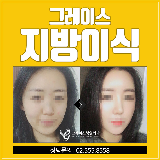 생기있고 탱탱한 동안얼굴, 그레이스성형외과 얼굴지방이식이 정답! 관련 이미지 4