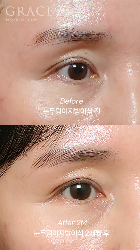 Why Do Hollow Eyelids Occur, and How Can They Be Naturally Improved? (Research Notes from a Doctor Performing Eyelid Fat Grafting) image 7
