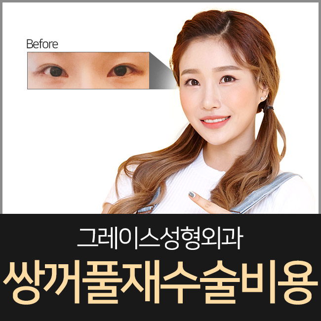 쌍꺼풀재수술비용을 알아본다면? 관련 이미지 1