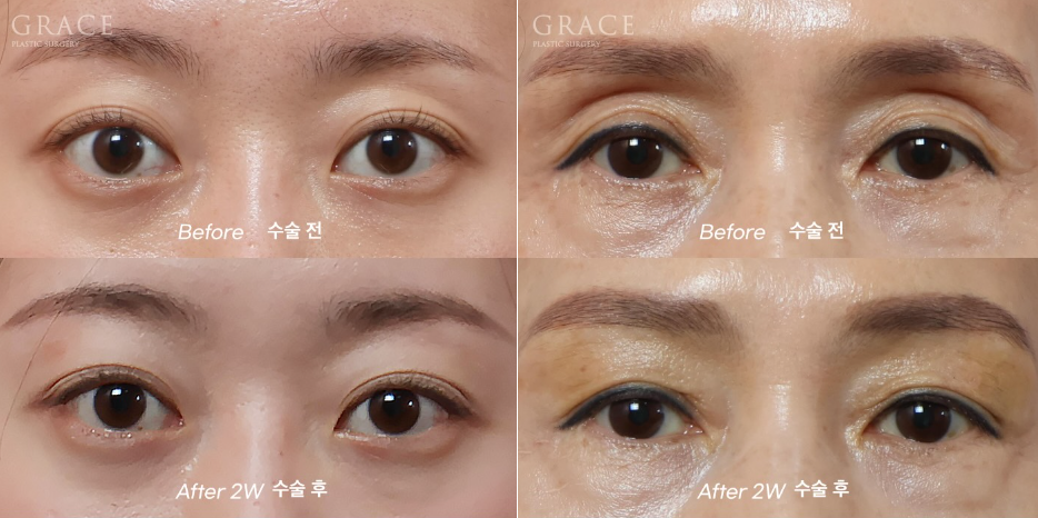 Why Do Hollow Eyelids Occur, and How Can They Be Naturally Improved? (Research Notes from a Doctor Performing Eyelid Fat Grafting) image 10