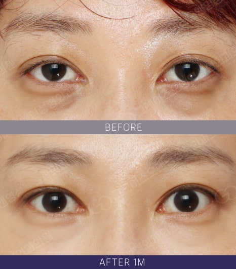 Hollow Eye Holes + Under-Eye Puffiness → (Upper Eyelid Fat Grafting + Fat Repositioning) image 8