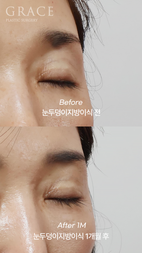 Eyelid Fat Grafting Side Effects? How to Settle In Beautifully Without Lumps image 7