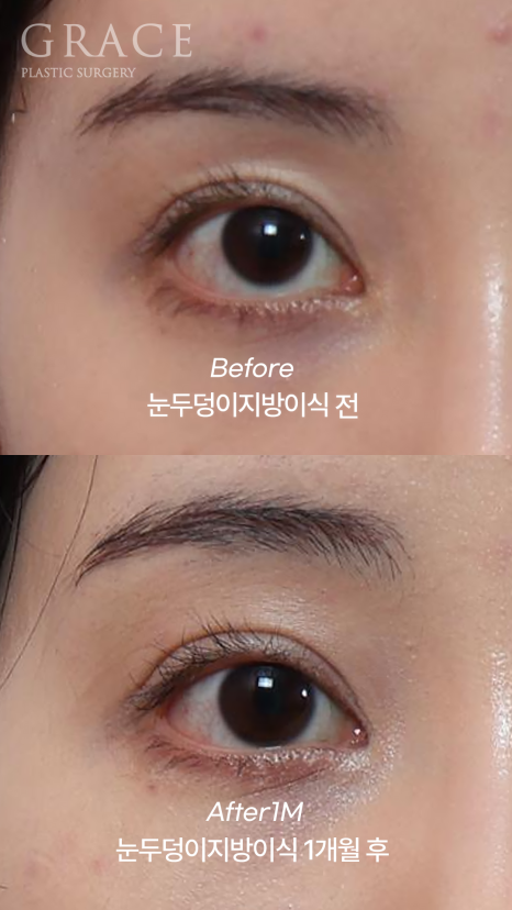 For Those Saddened by Sunken Eyelids (Upper-Eyelid Fat Grafting) image 8