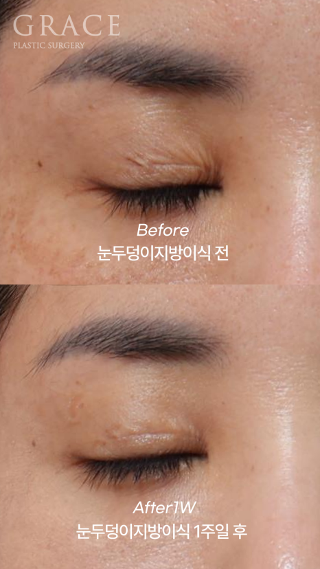 Week 1 After Upper Eyelid Fat Grafting in the Mid-40s: A Natural Return Without Swelling image 4