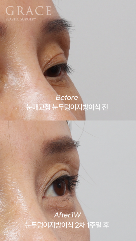 눈두덩이지방이식 2차 이식(리터치) 마취&지방채취 부위 등 관련 이미지 4