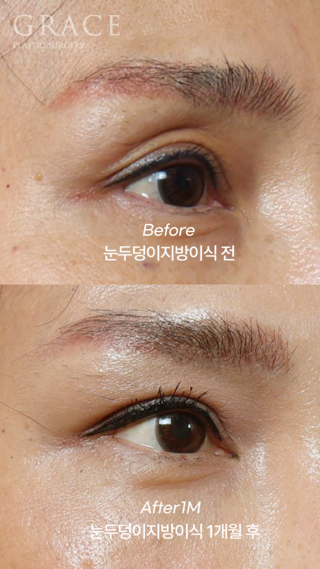 Uneven When You Close Your Eyes? Before-and-After of Eyelid Fat Grafting That Took Well Without Swelling (Compared with Filler) image 3