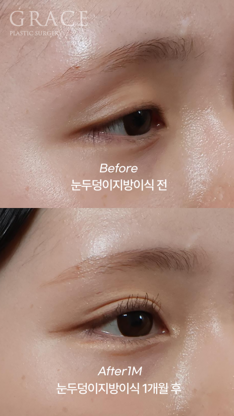 In Your Mid-20s, If You Have Ptosis Before and After Upper Eyelid Fat Grafting, Is Eye Correction Essential? image 4