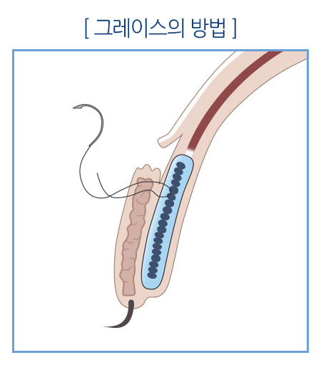재발한 안검하수 그레이스성형외과에서 해결! 관련 이미지 5
