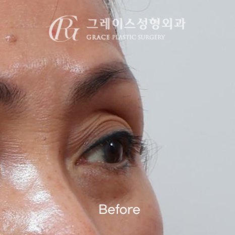 60대 눈꺼풀 고민 상안검 대신 선택한 눈두덩이 지방이식 관련 이미지 2