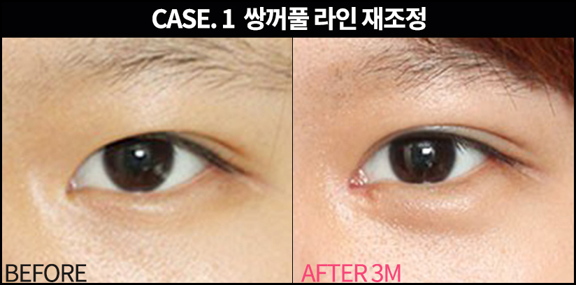 풀린 쌍꺼풀 재수술로 다시! 관련 이미지 1
