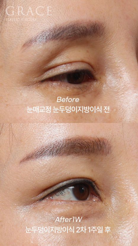 눈두덩이지방이식 2차 이식(리터치) 마취&지방채취 부위 등 관련 이미지 3