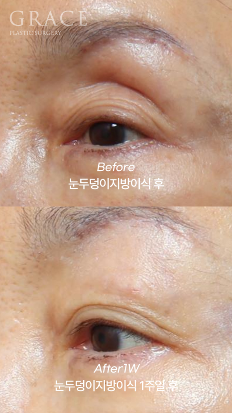 Upper Eye Hollowing and Sunken Brow Bone: Before and After 1 Week of Fat Grafting for a Patient in Her Mid-70s image 3