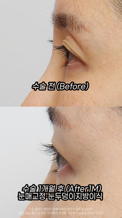 If Sunken Eyelids Are Left Untreated, About Hollows in the Eye-Hole Area (Fat Grafting) image 4