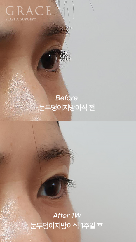눈꺼풀 지방이식 눈 감았을 때 울퉁불퉁하지 않는 이유 전후사례로 보여드립니다 관련 이미지 8