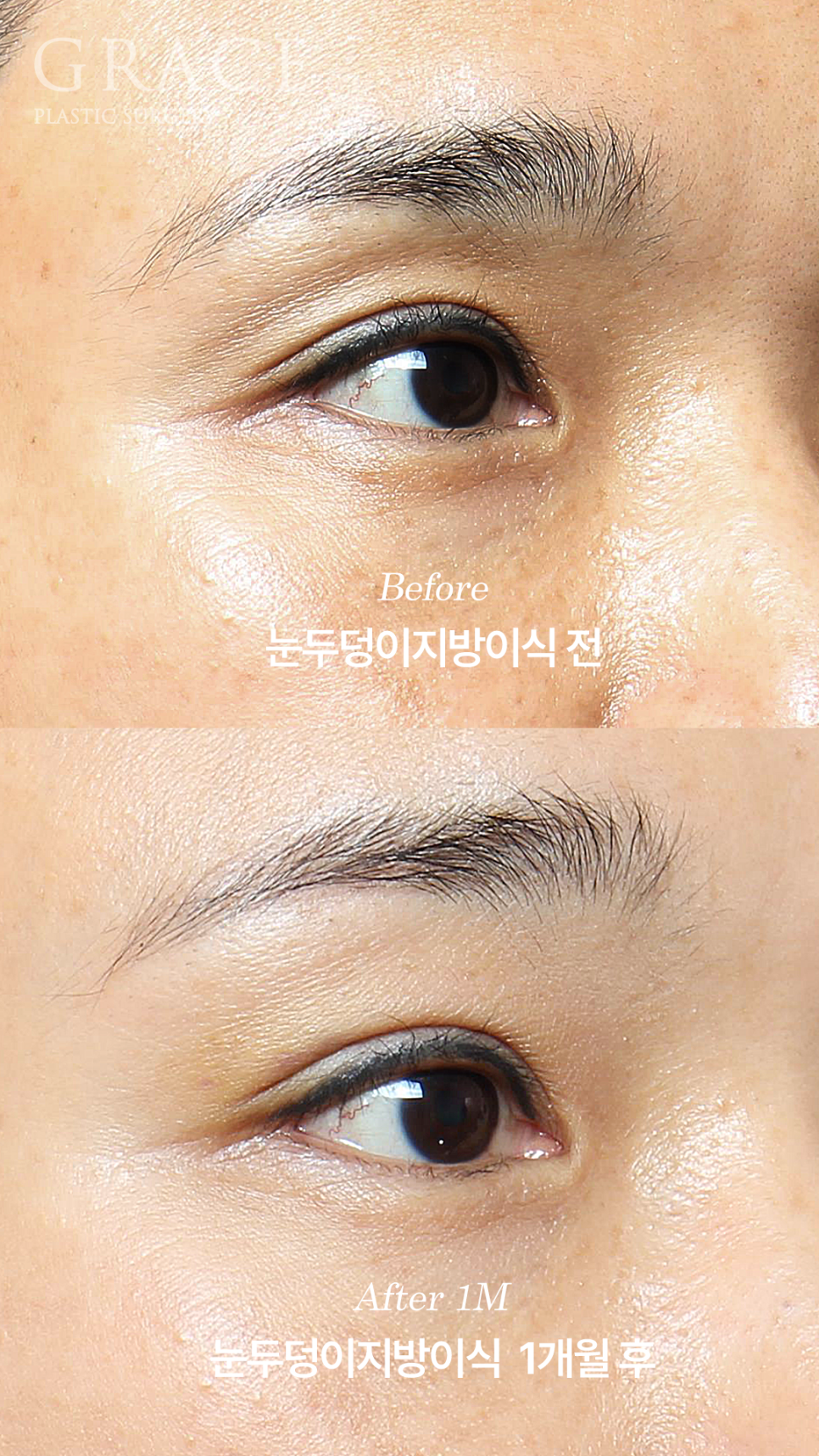 그레이스성형외과 눈두덩이 꺼짐 지방이식 전후 비교 관련 이미지 6