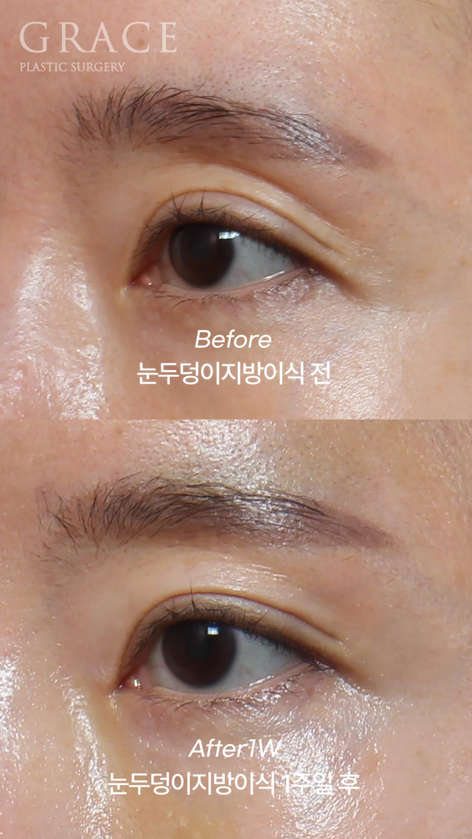 50대 눈꺼풀 지방이식 잘하는곳 염려되는 부작용 걱정까지 관련 이미지 1