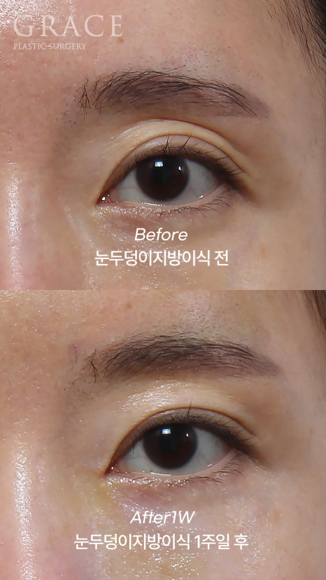 눈두덩이 지방이식 or 풀페이스 지방이식 유지기간&middot;부작용까지 정리 관련 이미지 3