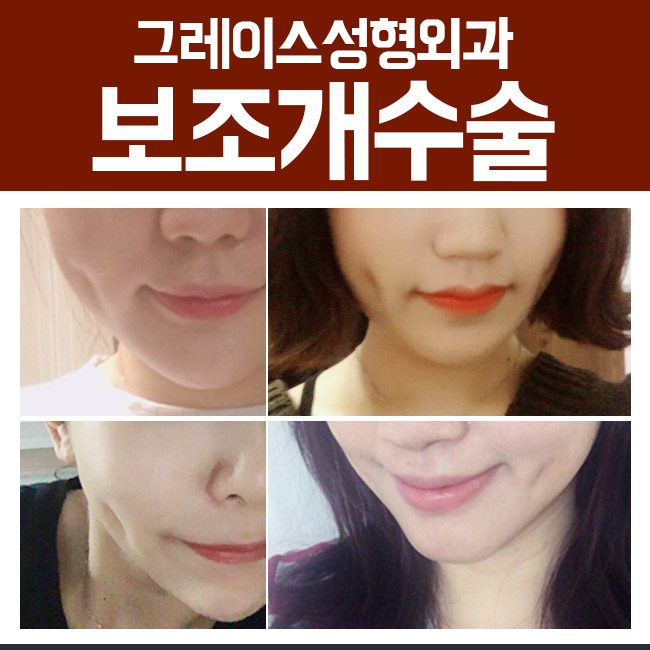설렘을 주는 미소 보조개수술후기를 알아본다면 관련 이미지 2