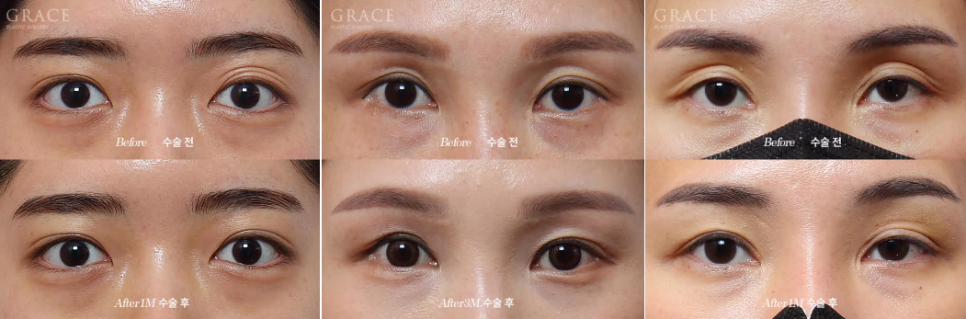 3 Things You Must Know Before Eyelid Fat Grafting image 3