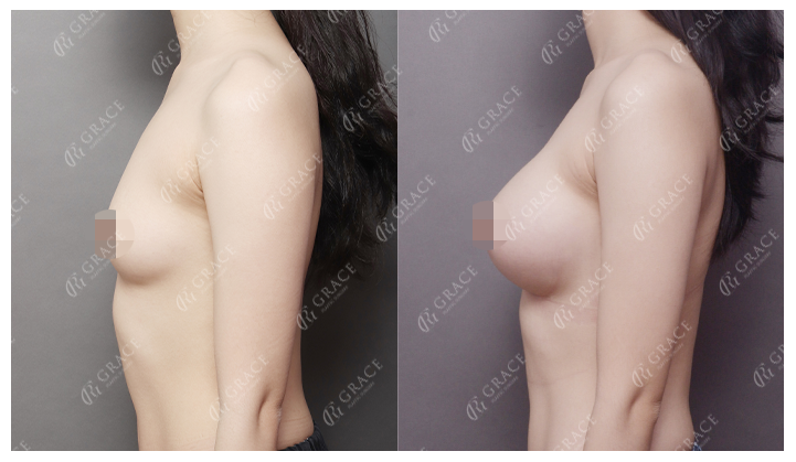 How Should You Choose a Good Breast Augmentation Clinic? image 6