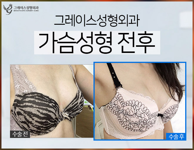 그레이스성형외과 모티바보형물 알아보기! 관련 이미지 3