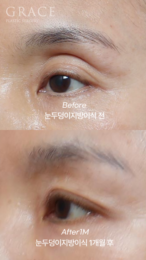 눈꺼풀 지방이식 절개 없이 아이홀 부위를 채우기 관련 이미지 3