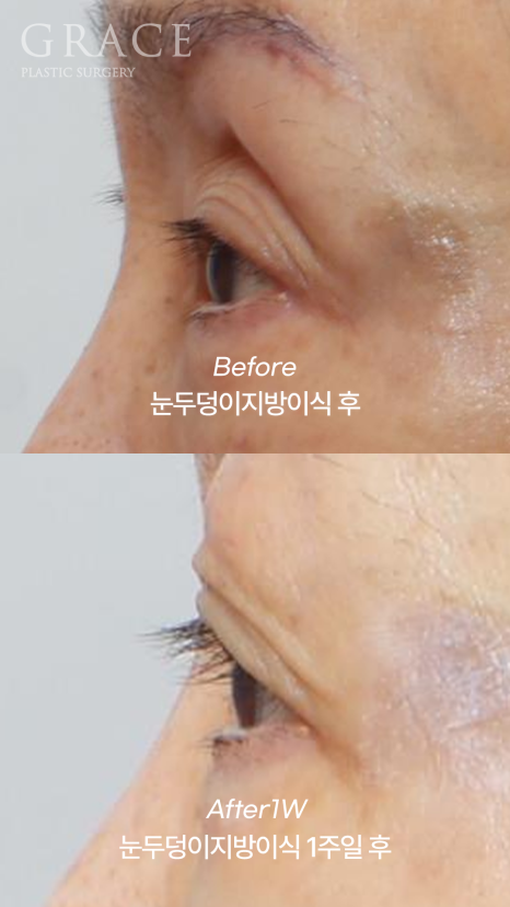 Upper Eye Hollowing and Sunken Brow Bone: Before and After 1 Week of Fat Grafting for a Patient in Her Mid-70s image 9