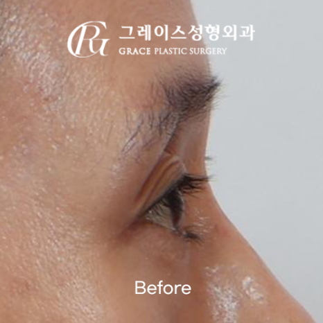 꺼진 눈 성형 1주일 붓기 보정 없이 솔직하게 보여드립니다 관련 이미지 5