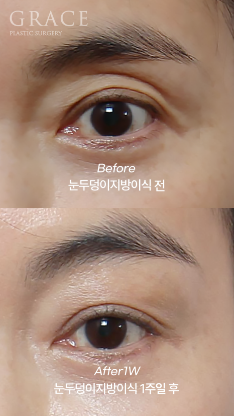 (2차 냉동지방X) 눈꺼풀 지방이식 붓기&부작용 없는 이유 관련 이미지 3