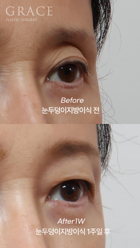 눈두덩이 지방이식 유지기간과 부작용까지 한 번에 정리 관련 이미지 6