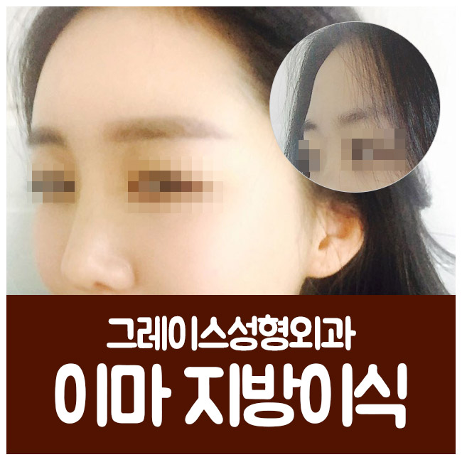 얼굴지방이식후기, 그레이스성형외과에서 알아봐! 관련 이미지 2