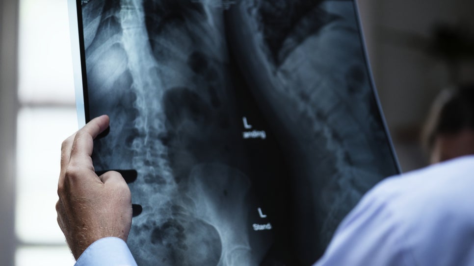 About Bone Fractures image 1