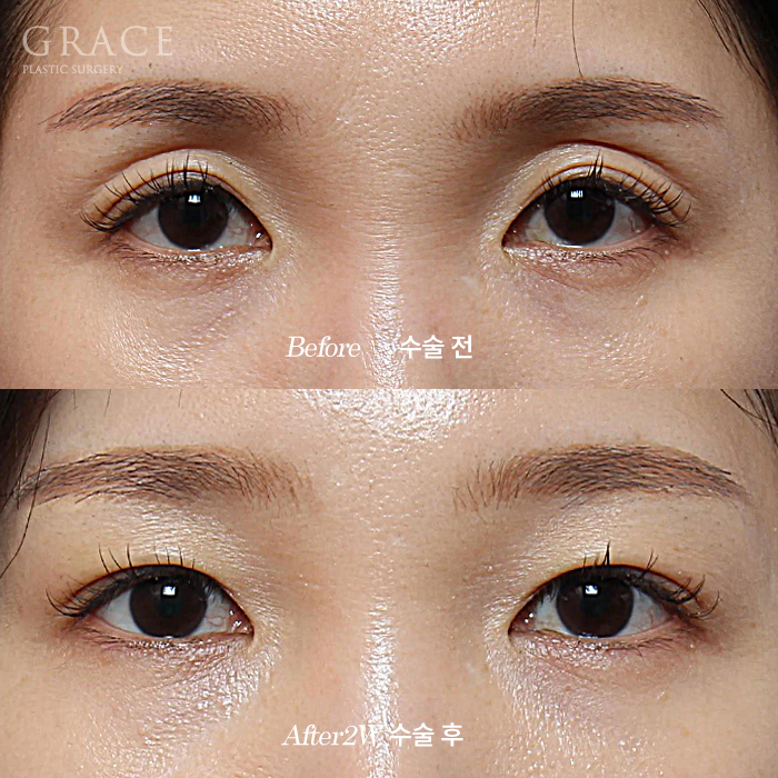 Double Eyelid Fat Grafting Fails When It Becomes Visible and Bumpy? image 1