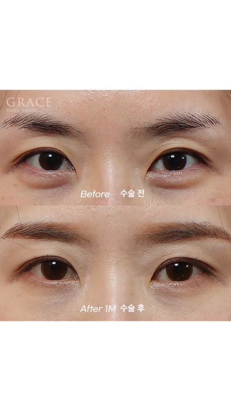 Eyebrow Hollow Fat Grafting Before and After Comparison – Gently Filling Sunken Eyes image 5