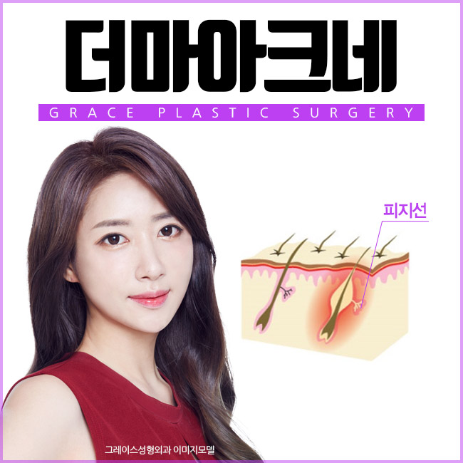 신개념 여드름치료 시술 더마아크네를 알아보자 관련 이미지 2