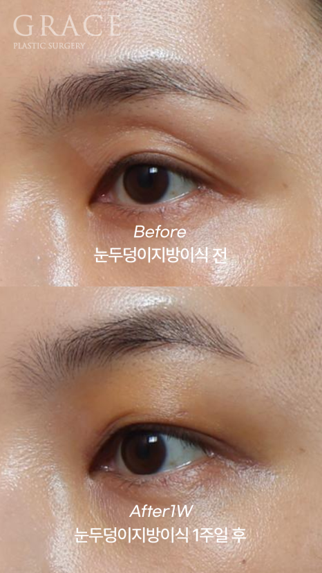 1 Week After Forehead Fat Grafting for Sunken Eyes: Honest Swelling Update image 6