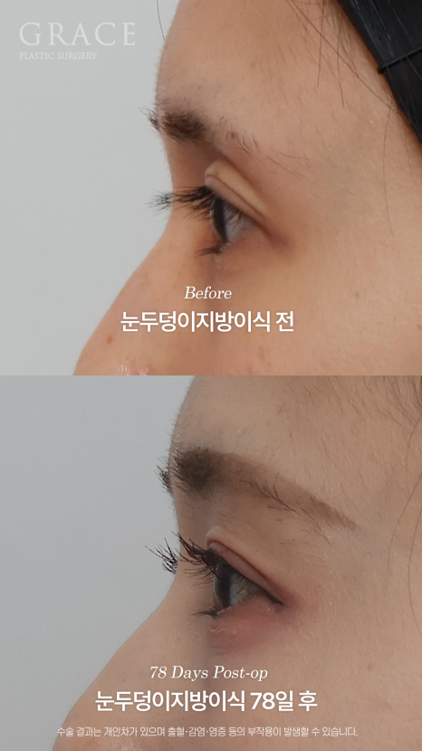 Will a Sunken Upper Eyelid Become Bumpy When You Close Your Eyes After Fat Grafting? image 18
