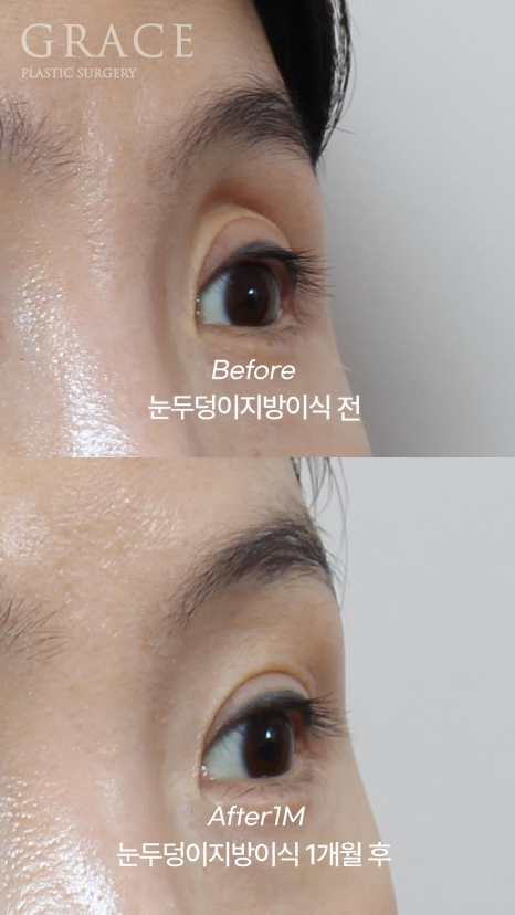 눈 위 지방이식 감으면 울퉁불퉁? 왜? 관련 이미지 4