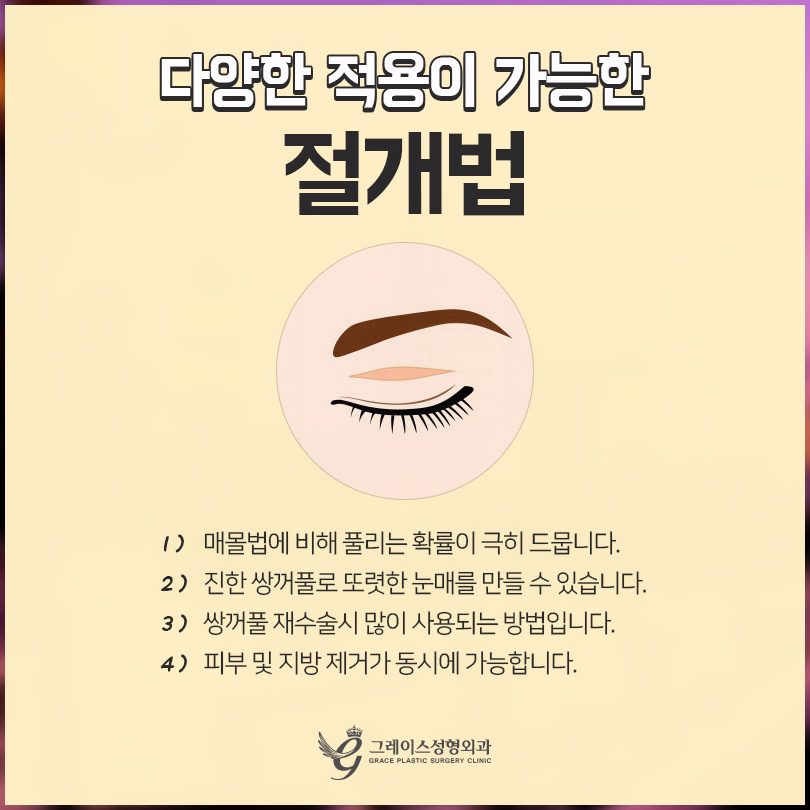 쌍수종류 자연유착?절개? 그레이스가 알려드려요 관련 이미지 5