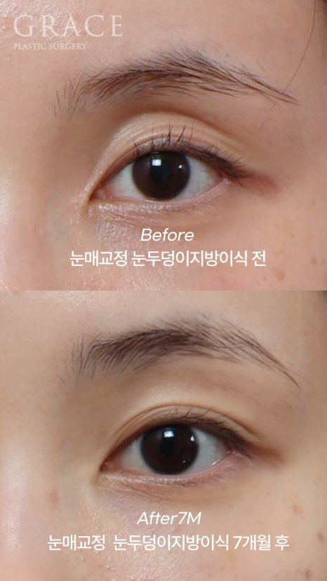 [20대 후반 눈꺼풀 지방이식+눈매교정]  7개월 후 유지력 이렇게 좋을 일? 관련 이미지 4