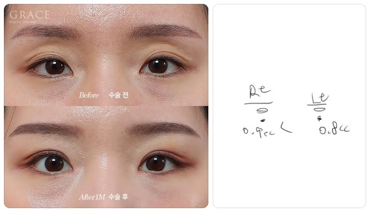 The Real Cause of Side Effects from Upper Eyelid Fat Grafting: the Injection Layer (Orbicularis Oculi Muscle & Orbital Fat) image 6