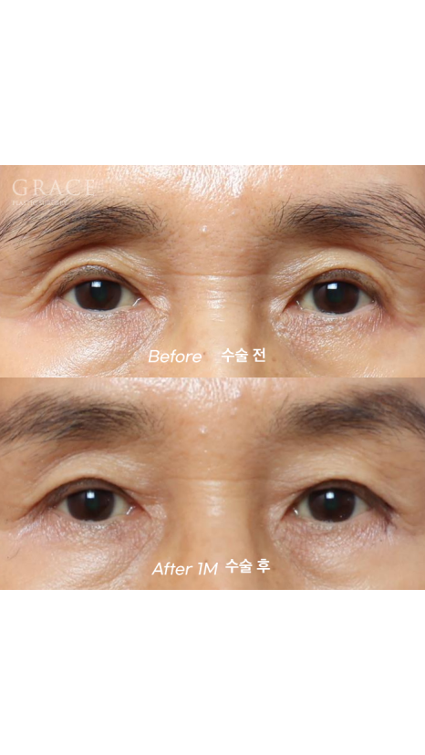 Will eyelid fat grafting be finished in one session? Progress after the first graft for a customer in their 60s and the planned second graft image 1
