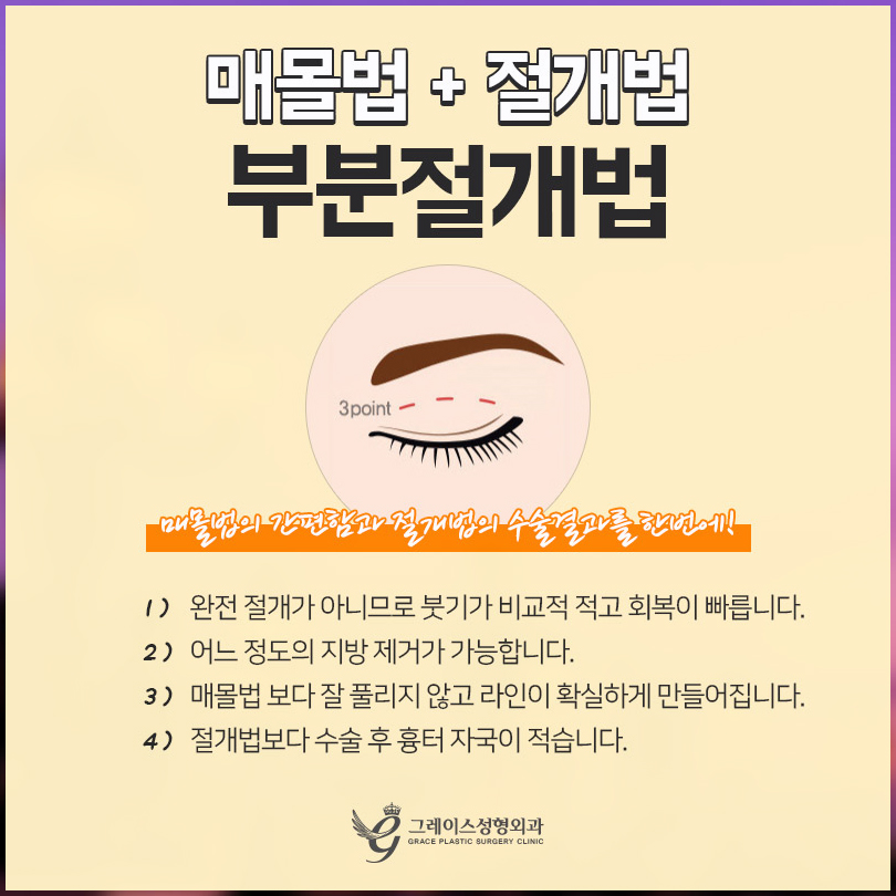 쌍수종류 자연유착?절개? 그레이스가 알려드려요 관련 이미지 6