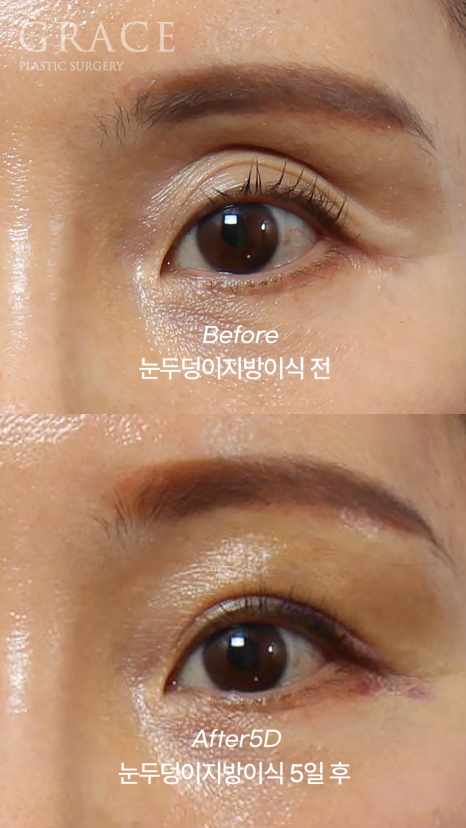 How Long Can Sunken Upper Eyelids Last Without Side Effects After Fat Grafting? image 4