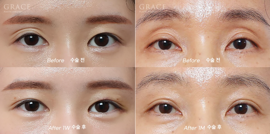 Grace Plastic Surgery’s Approach to Diagnosing Hollow Eye Socket Fat Grafting from the Structure image 5