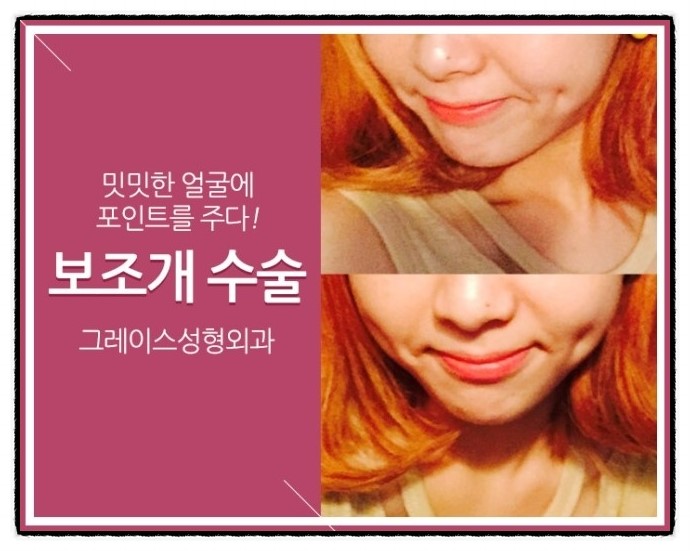 밋밋한 얼굴에 뽀~인트! 그레이스성형외과 보조개 수술 관련 이미지 3
