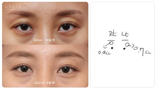 Complications from Sunken Eyelid Fat Grafting? The Injection Location Determines the Result image 9