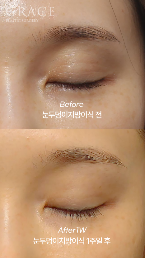 Will Eye Hollow Fat Grafting Really Deflate After 1 Month? 1-Week vs 2-Month Before-and-After Comparison image 4
