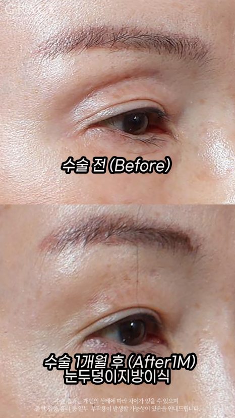 눈두덩이 지방이식으로 젊음을 되찾다: 70대, 40대 시술 전후 비교 관련 이미지 2